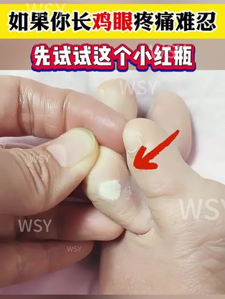 如果你的脚上也有这种情况,先试试我这个方法#鸡眼 #鸡眼去除小妙招 #鸡眼怎么能彻底根治 #鸡眼怎么去除 #鸡眼怎么造成的