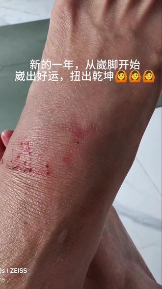 人生处处是惊喜,生活处处是意外!
据说蛇年崴脚挡大灾
我反正是信了,毕竟已经崴脚了#崴脚