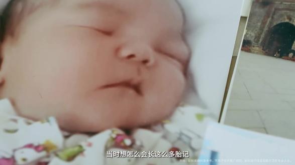 在百万分之五的不幸之中,寻找爱和希望!
“希望别人不要害怕我,我不是你们认为的怪物......”
“希望我能和同学们一起在教室上课......”
“希望有药物能治疗我的病,长大后当警察,不让生病的人、善良的人受欺负......”
这些话语来自一个小男孩。他叫瑞瑞,今年十一岁,I型神经纤维瘤病患儿。#神经纤维瘤病 #关爱泡泡宝贝