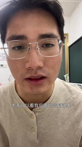 每天都会更新,三个月才算最终效果 别人的流言蜚语都不在乎,自己只要能恢复有效果就行了#痘痘#痘坑#皮下分离痘坑后的效果 #脂肪填充