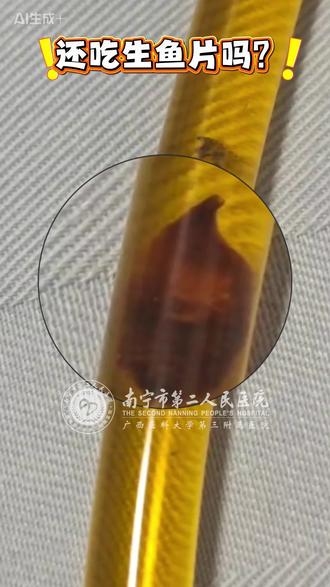 常年吃鱼生,他的右肝已被肝吸虫“掏空”!医生提醒:通过忌口可避免肝损伤!肝炎→肝硬化→肝癌是“肝病三部曲” #肝吸虫 #鱼生 #两广美食 #健康 #全国爱肝日