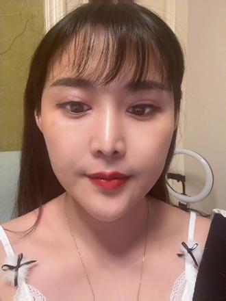 双眼皮修复第34天#马娟双眼皮修复 双眼皮马娟