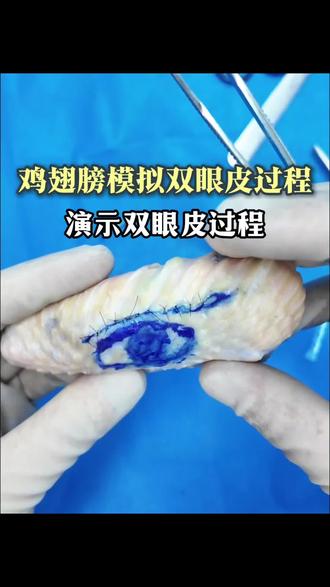 鸡翅膀小姐姐做双眼皮是一种什么体验 #医学科普 #双眼皮 #全切双眼皮 #整形医生 #鸡翅膀