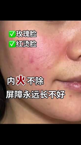 内火不除,屏障永远长不厚 #屏障受损#脸上泛红发痒怎么办 #脸上发红发烫 #红烫肌#玫瑰痤疮脂溢性皮炎
