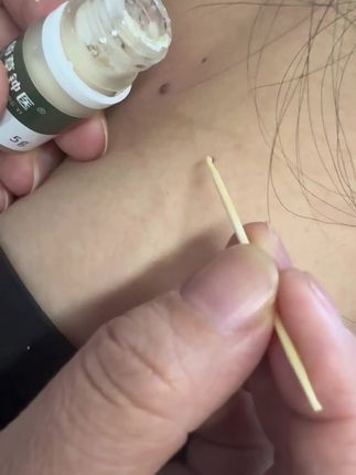 #脖子上的小肉粒 #脖子上的小啾啾 #丝状疣 #疣体祛除