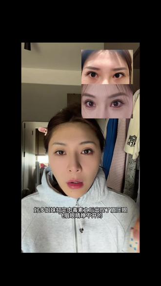 肉毒素眉压眼怎么办? 肉毒素眉压眼可以这样做!#肉毒素眉压眼 #肉毒素注射 #英伦大提升#肉毒素