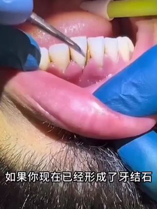 #爱牙护牙 #洁牙仪 #洁牙仪牙结石清洁牙垢洗牙工具