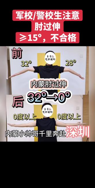 军校/警校生请注意。看看胳膊下掉,不能考军校/警校。内蒙古肘过伸32º→0º,恭喜恭喜#肘外翻#高考提前批#警校 #军校#肘过伸