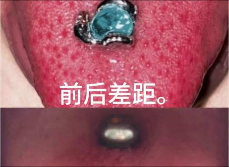 有没有刚打舌钉觉得平平无奇的姐妹!前后反差来了。 有没有刚打舌钉觉得平平无奇的姐妹!刚穿刺完只能戴基础的医用钛合金,舌头又红又肿,吃东西刺痛,说话都不自在,看着简简单单的钢珠完全没氛围感,一度觉得不好看。
但只要耐下心好好养护真的会大变样!坚持清淡饮食,每天生理盐水清洁口腔,不随便用手碰、不吃辛辣烫口的食物,等创口完全长稳定之后,就能自由更换各种好看的饰品。
换上这款蓝钻小蜗牛舌钉瞬间氛围感拉满,清透蓝色宝石搭配小众造型,拍照巨吸睛,对比刚打完朴素的基础钉,前后差距直接一目了然。
其实所有穿孔都离不开细心护理,熬过恢复期,就能搭配自己喜欢的漂亮钉,小众又独特,喜欢口腔穿刺的姐妹一定要认真养护自己的伤口!
#舌钉 #舌钉养护 #穿孔科普 #口腔穿刺 #穿刺分享