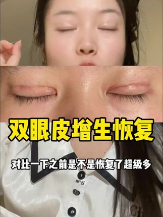 芭克是真的有使#芭克去疤膏 #芭克 #芭克硅凝胶