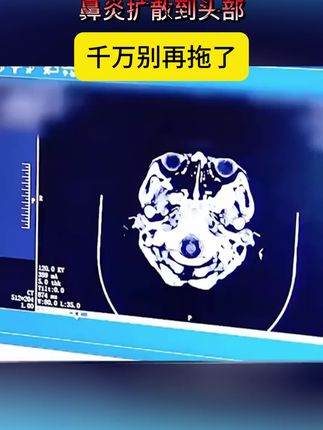 lefeke秝客生理性海水鼻腔喷雾器鼻炎喷雾剂海盐水洗鼻鼻息肉鼻炎喷剂海盐水洗:/ 鼻鼻炎温和清洗】#生理盐水 #生理海盐水