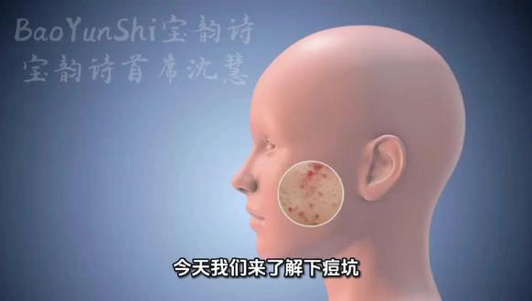 痘坑的成因及修复方法分享