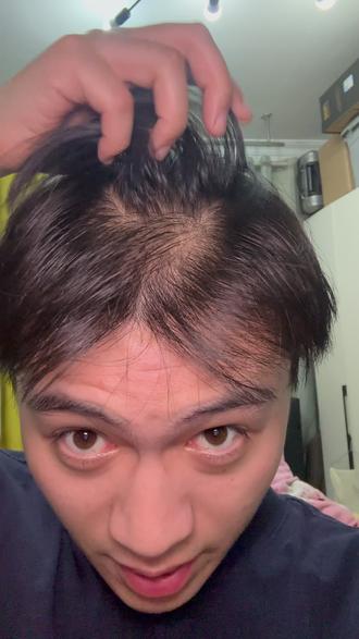 父母头发都很好为什么我会脱发😭 #雄脱 #遗传性脱发 #掉发 #焦虑 #脱发