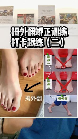 拇外翻根本不是骨头歪了!
90%后天拇外翻
都是前足发力不对导致的‼️
大脚球压不住地
脚趾长期乱挤受力
大脚趾才慢慢外翻变形
别再乱戴矫正器硬掰了
抓住核心👇
重建前足旋前能力
恢复大脚球压地发力
发力正了,拇外翻自然慢慢回正✅
#拇外翻 #拇外翻矫正 #足部发力 #体态纠正 #健康科普