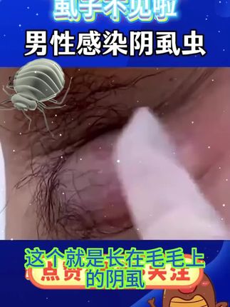 仁和药业百部酊喷雾剂男女阴用成人祛除虱子虱卵虱立净一扫光正品#长虱子怎么消除 #消除虱子卵的小妙招 #身上长虱子怎么消除 #草本植物 #百部酊喷剂语音转文字