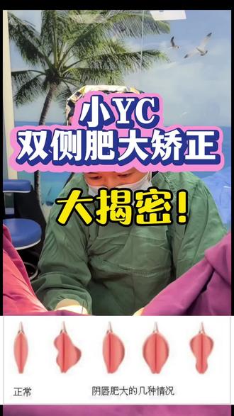 小YC肥大手术揭秘,手术指征主要看有没有引起不适及生活不便,可以不住院局麻下完成手术,术前敷麻药后手术过程中不会有疼痛感,术后的疼痛可以吃止痛药缓解!#小YC肥大 #小樱唇 #局部麻醉 #止痛药