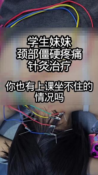#2026先定一个小目标 学生妹妹颈部僵硬疼痛,针灸治疗揭秘 #学生妹 #颈椎病 #针灸 #上课 你也有上课坐不住,必须跷二郎腿的情况吗