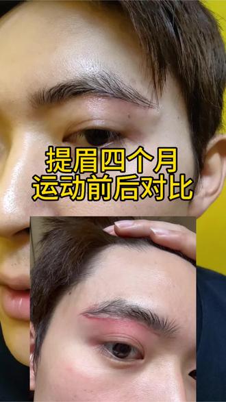 提眉四个月,运动前后疤痕对比#提眉 #男生提眉