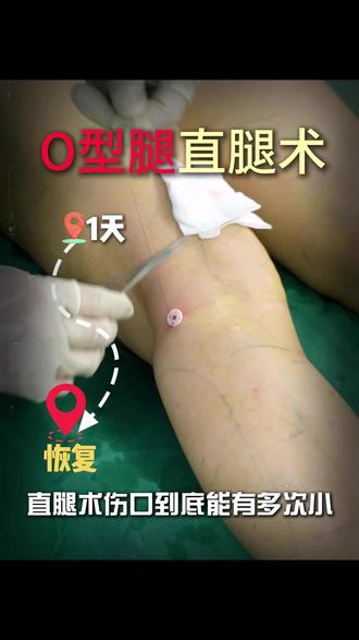 do腿后怕被看出来?这个不用担心~#矫正腿型 #直腿术 #知识科普 #腿粗 #瘦腿