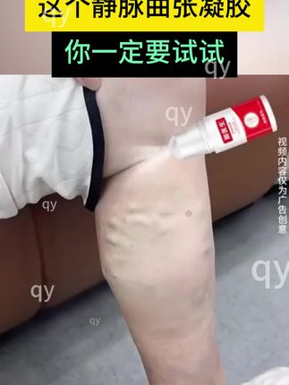 所有静脉曲张的朋友,你一定不能错过它#静脉曲张 #静脉曲张微创 #静脉曲张怎么办 #静脉曲张手术 #静脉曲张老烂腿