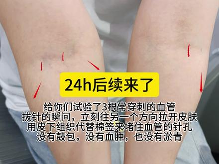 这三根常穿刺的血管都给你们试过了,亲测有效,拔针瞬间立即按压,压够两分钟,就不会淤青 #真实生活分享计划 #越南止血法 #越南 #医疗知识科普 #止血