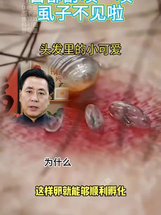 又给大家挖到宝贝啦!它们的克星找到了,一起来看看吧!#百部酊 #百部酊喷剂#虱子 #虱子卵
