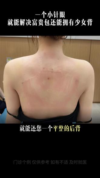 仅需1-2个小针眼,就可以微创方法解决富贵包、斜方肌问题, #富贵包 #斜方肌肥厚 #富贵包手术