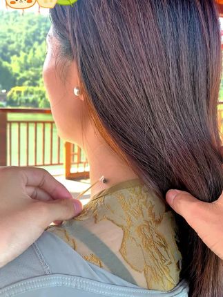 #脖子上的小肉粒怎么去除 #变美就是这么简单