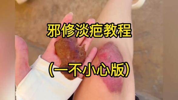 邪修#淡疤 教程(一不小心版)#疤痕#祛疤#好物推荐#杜伦凝胶