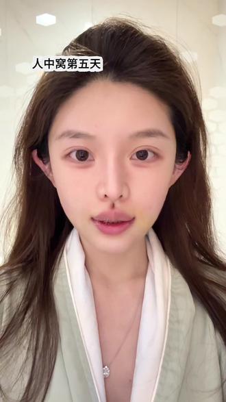 人中窝五天分享
#人中窝加深 #微笑唇 #人中 #嘴角上扬 #罗澜涛