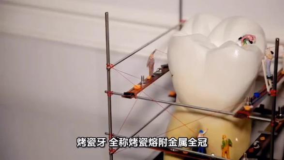 什么情况下需要做烤瓷牙?