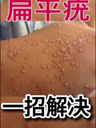 身上长了扁平疣怎么办,一支小药膏帮您解决,北京同仁堂去疣凝胶,每天涂一涂轻松脱落,链接🔗帮大家放到下面了,有需要的下单吧#扁平疣 #丝状疣 #脖子上的小肉粒 #疣 #去疣