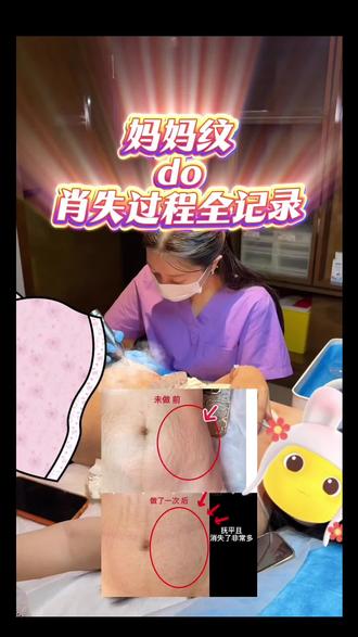 肤色重建师工作全记录!#产后恢复 #妊娠纹 #宝妈 #肤色重建 #vlog