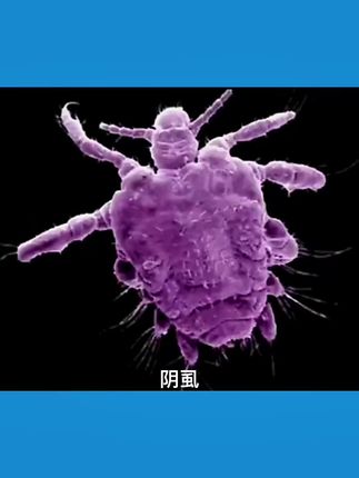 #虱子 #阴虱#百部酊去头虱 #百部酊的正确使用方法 #百部酊去虱卵