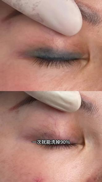 六安洗眼线1次就能干净#六安洗眼线 #洗眼线 #洗眼线几次可以洗干净 #洗眼线疼吗 #洗眼线视频全过程