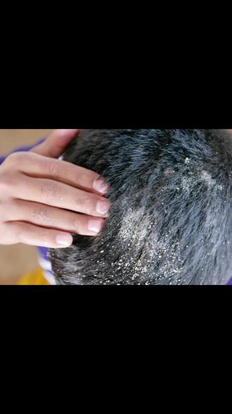 【央妈力荐】二硫化硒洗发水,控油去屑超给力!洗完头发蓬松又香香,头皮清爽一整天~🌿✨ #控油神器 #去屑必备#爱兰歌娜二硫化硒洗发水 #好物分享