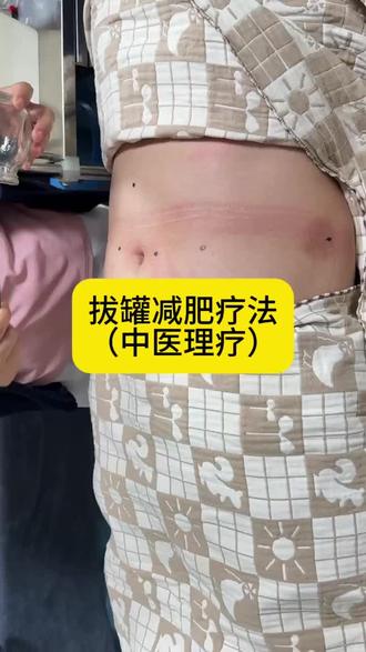 #中医 #中医养生 #拔罐 中医理疗——拔罐减肥疗法