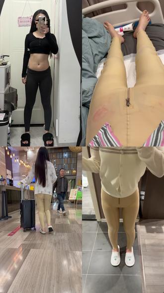 裸辞去Do腿 #抽脂 #大小腿环吸 #变美变瘦变好看 #大象腿