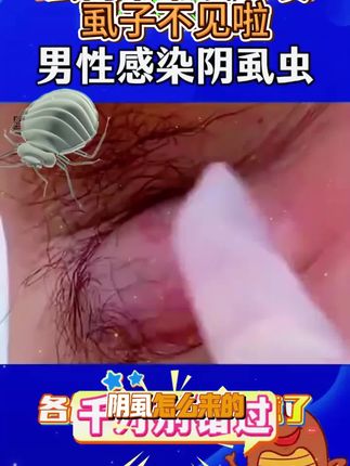 仁和药业百部酊喷雾剂男女阴用成人祛除虱子虱卵虱立净一扫光正品#长虱子怎么消除 #消除虱子卵的小妙招 #身上长虱子怎么消除 #草本植物 #百部酊喷剂语音转文字