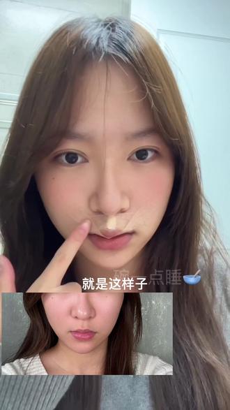 人中窝嘴角护理来了 目前九天啦很自然#嘴角上扬 #人中窝加深 #原相机无美颜滤镜 #勇敢的人先享受世界