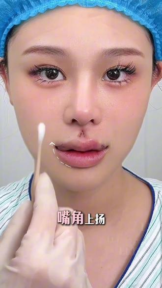 好喜欢我的微笑唇 #医美分享 #罗澜涛人中 #微笑唇 #嘴角上扬 #嘴角下垂