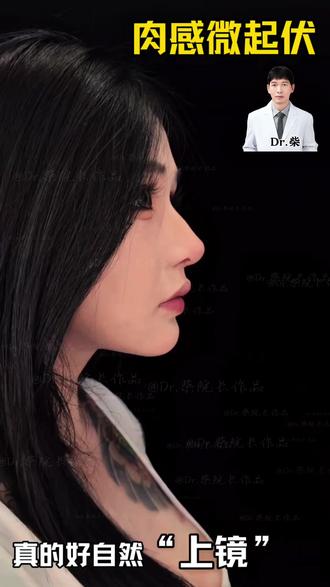 这鼻子👃做的太完美啦,有需要的私信了解
非常年轻好看立体感、饱满#上海专家柴军案例