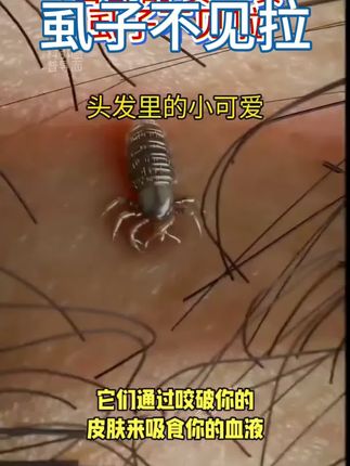 仁和药业百部酊喷雾剂男女阴用成人祛除虱子虱卵虱立净一扫光正品#长虱子怎么消除 #消除虱子卵的小妙招 #身上长虱子怎么消除 #草本植物 #百部酊喷剂