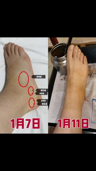 #骨折 #骨折恢复记录 #骨折康复 #崴脚
