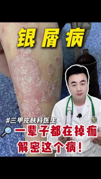 一辈子都在掉痂,解密这个皮肤病——银屑病!#牛皮癣#银屑病 #抖出健康知识宝藏 #健康科普破圈计划