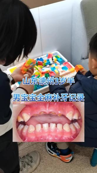 视频记录山东德州3岁半男宝宝3个小时全麻补牙#育儿互助交流上抖音 #儿童全麻补牙