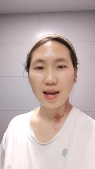 在线求助胎记宝宝们#经验分享 #鲜红斑痣 #胎记