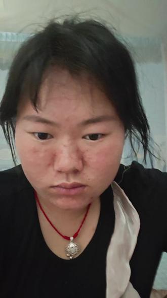 #水痘 怎么办呀?怎么办呀?怎么办呀?怎么办呀?第三天