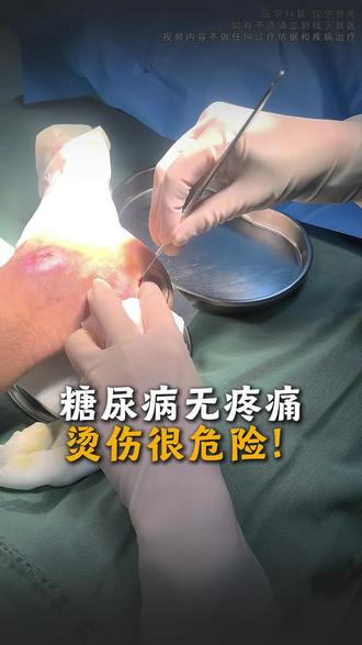糖尿病无疼痛烫伤很危险! #沈阳 #张珊珊医生 #糖尿病足 #烫伤 #创面修复