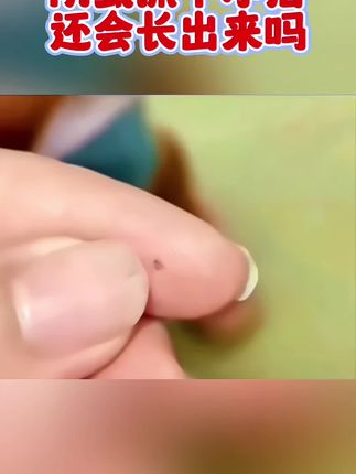 #虱子卵#头虱#头发上有虱子怎么办#消除虱子卵的小妙招#男女通用@巨量千川